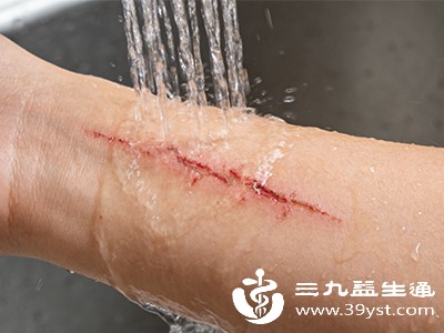 抓伤怎么马上消 实用小妙招来帮忙