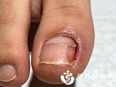 反复指甲脱落的情况