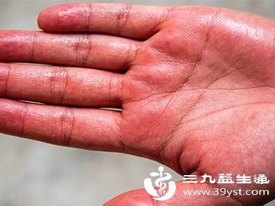 男人手掌红别忽视 可能是身体在“说话” 这些原因要了解