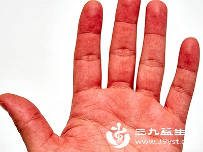 糖尿病患者若长期血糖控制不佳，可能导致周围血管病变，引起手掌发红，同时可能伴随手脚麻木、感觉减退等症状