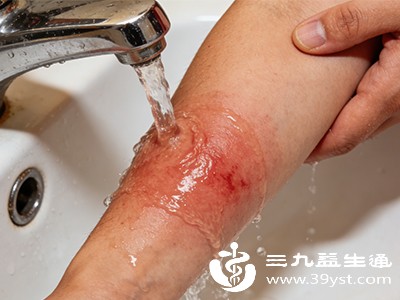 被热水烫了别慌 第一时间这样做 减轻伤害还止痛 快记牢