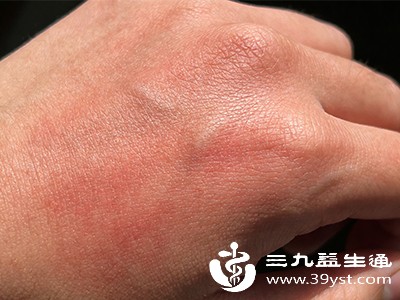 手背发红别大意可能是外界刺激或健康信号 原因都在这