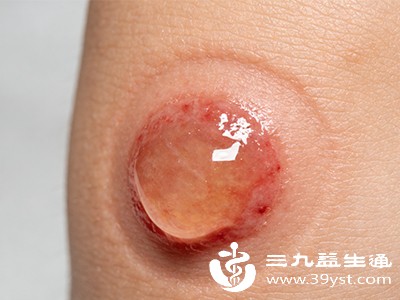 纠结烫伤水泡要不要弄破 先看这几点 科学处理更安全
