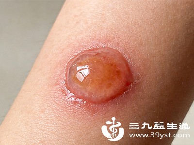 这类水泡体积小、液体少，通常可在3-7天内自行吸收