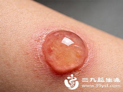 保持伤口清洁 保持伤口清洁