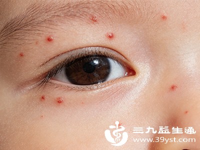 宝宝眼周小红点藏隐患 从常见到特殊情况 家长该这样应对