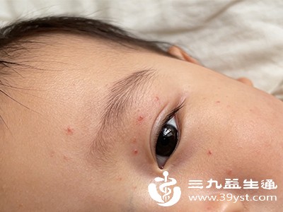 食物过敏 食物过敏