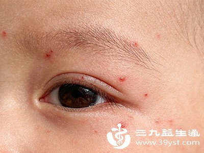 蚊虫叮咬 蚊虫叮咬