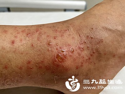 皮肤瘙痒,易起湿疹 皮肤瘙痒,易起湿疹