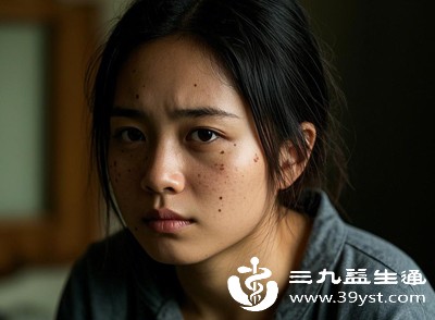 色斑多分布于面颊两侧