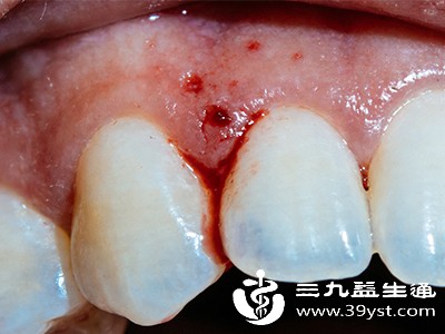 牙龈炎、牙周炎等口腔疾病，会导致牙龈出血，血液可能在漱口或吐痰时与痰液混合，让人误以为是呼吸道出血