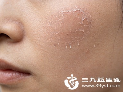 脸干起皮怎么办 找准原因这样护 告别脱屑紧绷超简单