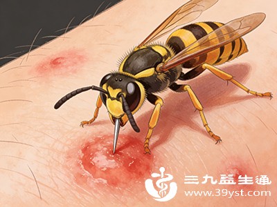别让黄蜂蜇伤毁了好心情 科学处理方法在此消肿止痛一步到位