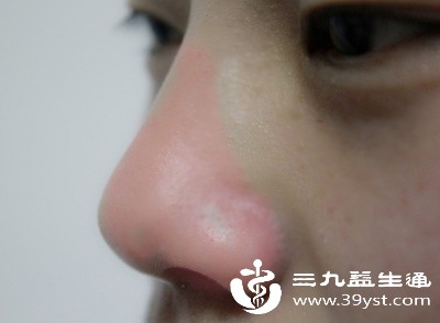 鼻头大想缩小 这些自然方法超实用 坚持做就能见效