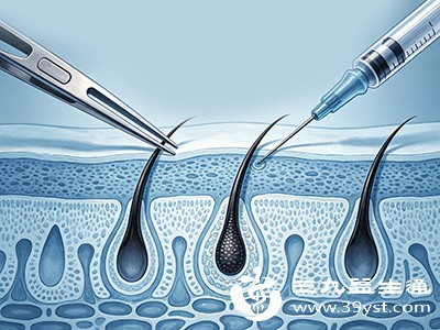 想长期变低可选正规机构毛囊种植