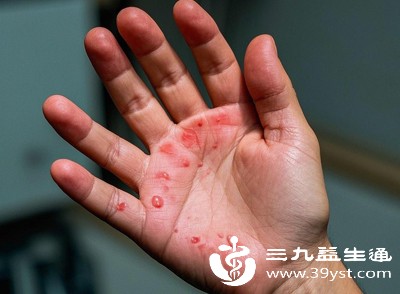 小水泡是皮肤自我保护的屏障,可防止细菌侵入 小水泡是皮肤自我保护的屏障,可防止细菌侵入