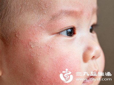 湿疹、接触性皮炎等皮肤炎症疾病，也会导致皮肤出现脱皮