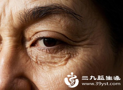 皱纹(尤其是眼周、嘴角的细纹)增多 皱纹(尤其是眼周、嘴角的细纹)增多