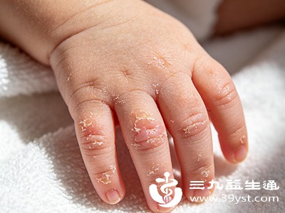 小孩手指脱皮别乱处理 先看这4个原因科学护理才靠谱