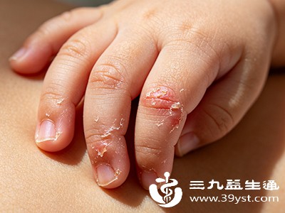 小孩接触玩具上的化学物质、橡皮泥、化纤衣物后，手指可能先出现红斑、丘疹，再逐渐脱皮