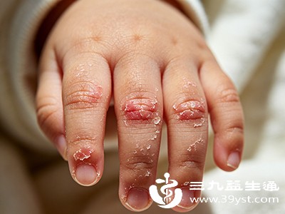 脱皮蔓延至手掌、手背，甚至其他部位皮肤