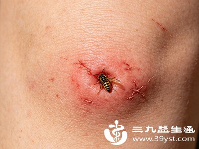 黄蜂蛰了能自然好吗 不是所有情况都能等