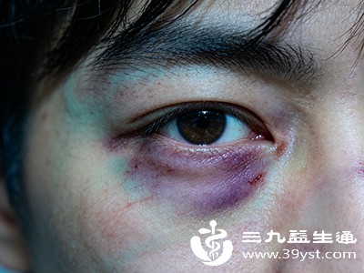 去眼部淤青最快的秘诀 分阶段处理+护理指南