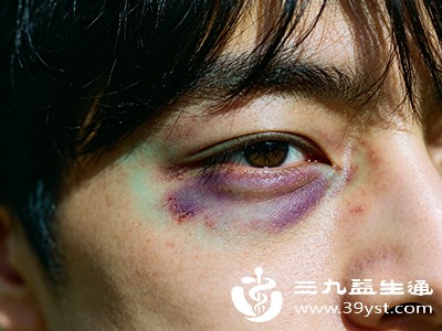 48小时后皮下出血基本停止，此时需通过促进血液循环，加速淤血吸收