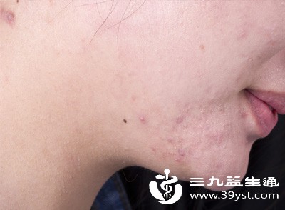 直接用于红痘印区域易引发刺痛、脱皮