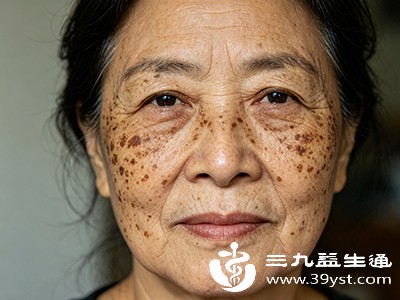 还有人觉得“老龄斑不影响健康，不用处理”