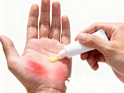 手烫伤起泡要挑破吗 正确处理方法看这里