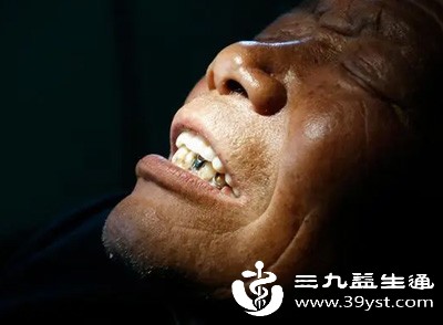 牙龈炎进一步发展会形成牙周炎，细菌会破坏牙周膜和牙槽骨