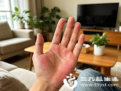 手掌大鱼际、小鱼际部位片状发红，即“肝掌”