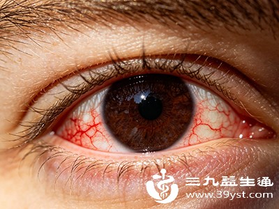 炎症可能伴随眼睛发红、瘙痒、分泌物增多等症状