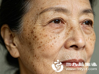 脸上冒出老年斑温和护理+专业干预 帮你找回干净肌肤