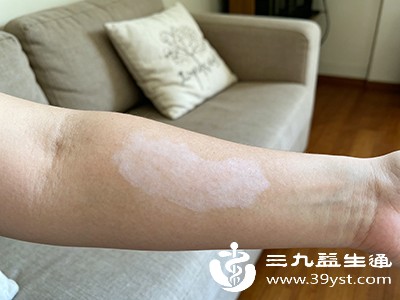 身上长白块咋回事 4类常见原因教你初步分辨