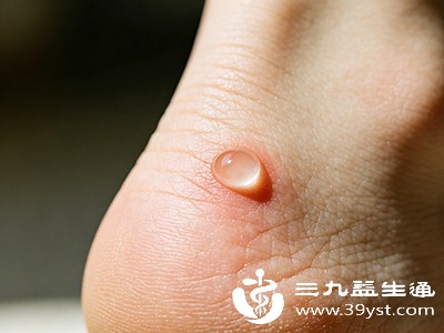 水泡超过1周还没好,或者好了之后同一地方又磨出水泡,可能是鞋不合脚 水泡超过1周还没好,或者好了之后同一地方又磨出水泡,可能是鞋不合脚
