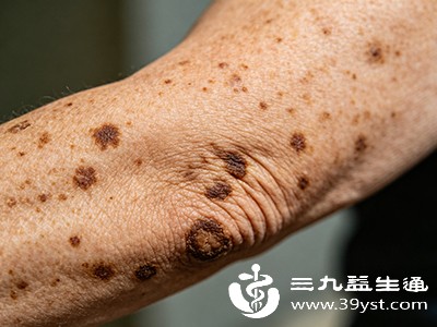 手背上的斑从哪来 这些常见诱因帮你找答案