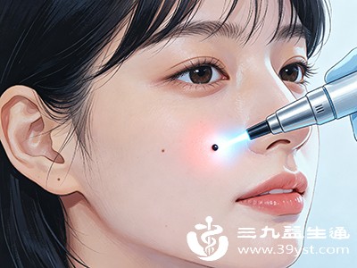 点痣前必看 这5类潜在危害可能影响皮肤健康
