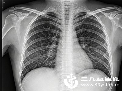 胸片提示肺纹理异常 不是大病信号但这些情况要警惕