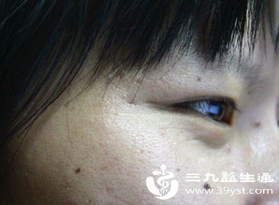 凸起较大的肉痣、长毛痣、交界痣、靠近五官危险三角区的痣，不建议盲目去除