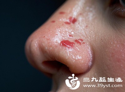 长期的气流摩擦会导致左侧鼻腔黏膜干燥、糜烂,从而频繁出现出血症状 长期的气流摩擦会导致左侧鼻腔黏膜干燥、糜烂,从而频繁出现出血症状