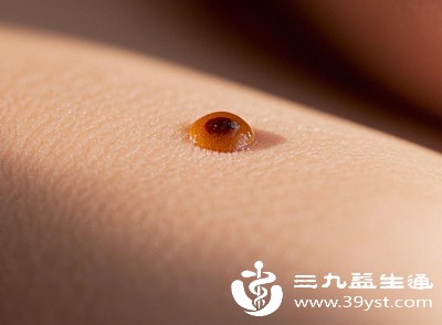 敏感肌本身皮肤屏障就脆弱,白醋的酸性会直接破坏皮肤屏障,导致过敏反应加重,出现剧烈瘙痒、红肿、脱皮等症状 敏感肌本身皮肤屏障就脆弱,白醋的酸性会直接破坏皮肤屏障,导致过敏反应加重,出现剧烈瘙痒、红肿、脱皮等症状