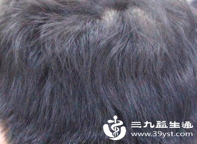 雄激素性脱发人群,最适合植发 雄激素性脱发人群,最适合植发