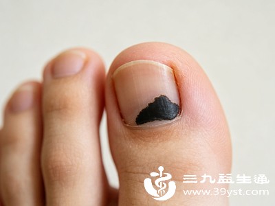 脚上莫名出现黑块 不是脏也不是磕碰 可能是身体发出的信号