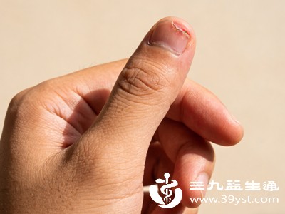 手上长倒刺不是缺营养竟是这3个习惯在搞鬼 附低成本防护法