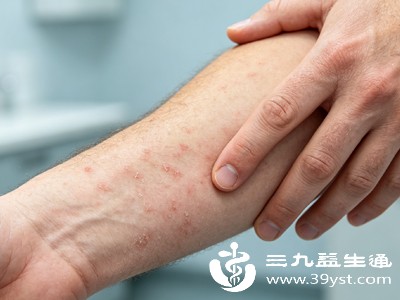 皮肤瘙痒症能自愈吗 分清真假瘙痒 不用乱吃药乱涂药