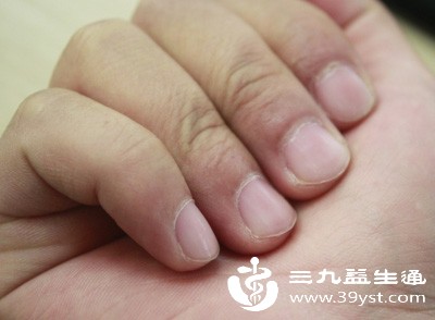 指甲横纹藏健康密码 生理性vs病理性区别在哪 看完这篇不慌了