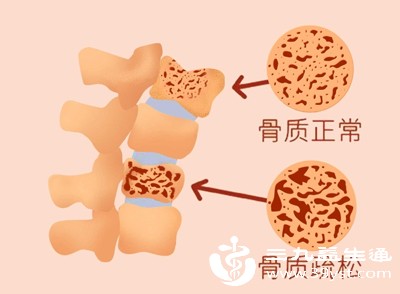 中老年人，缺钾可能会加重骨质疏松的症状，大幅增加骨折风险，需要格外留意