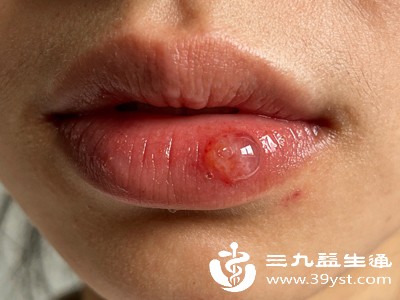 嘴上起泡影响吃饭说话 在家就能操作的小妙招 轻松搞定